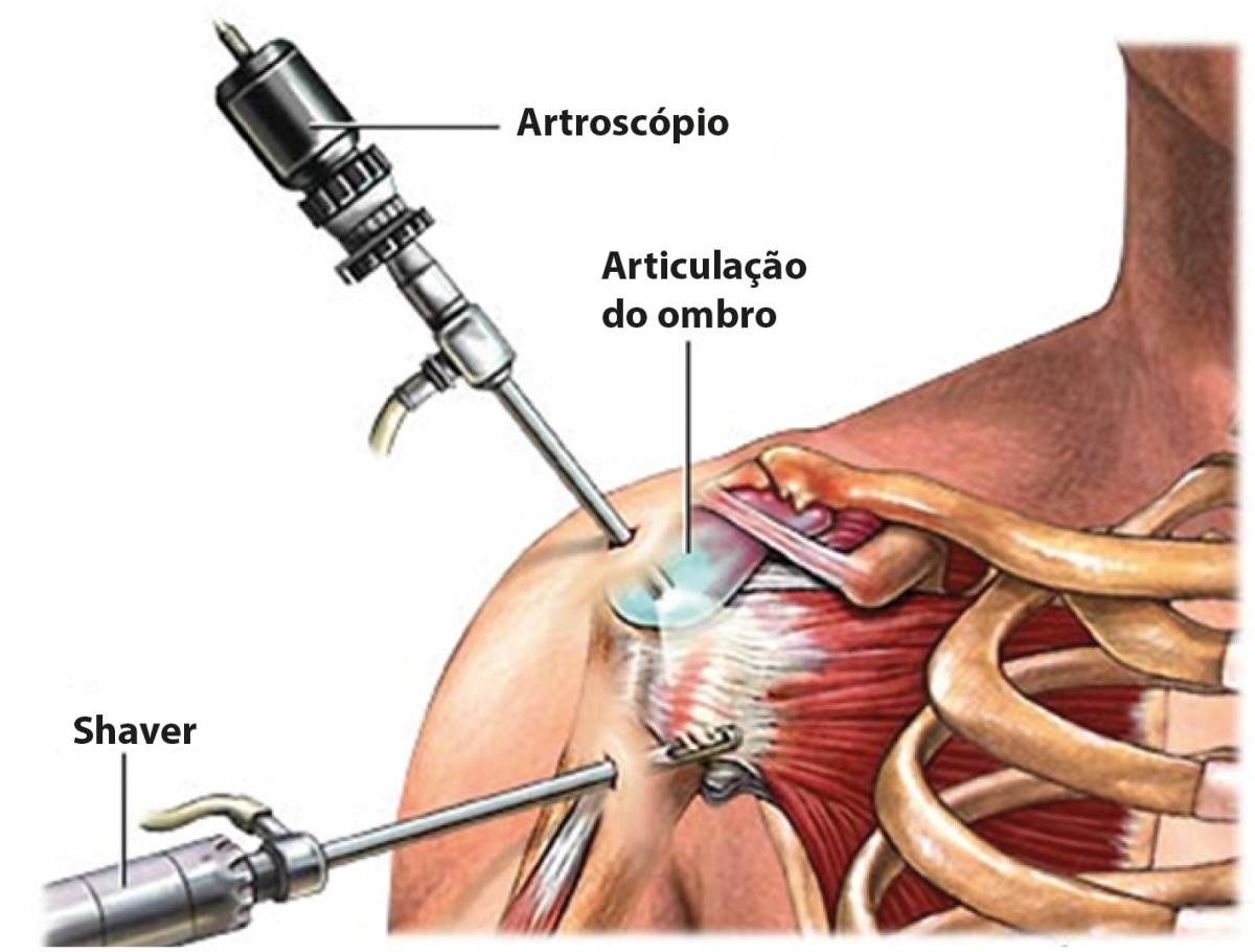 ARTROSCÓPIO ORTOPEDIA